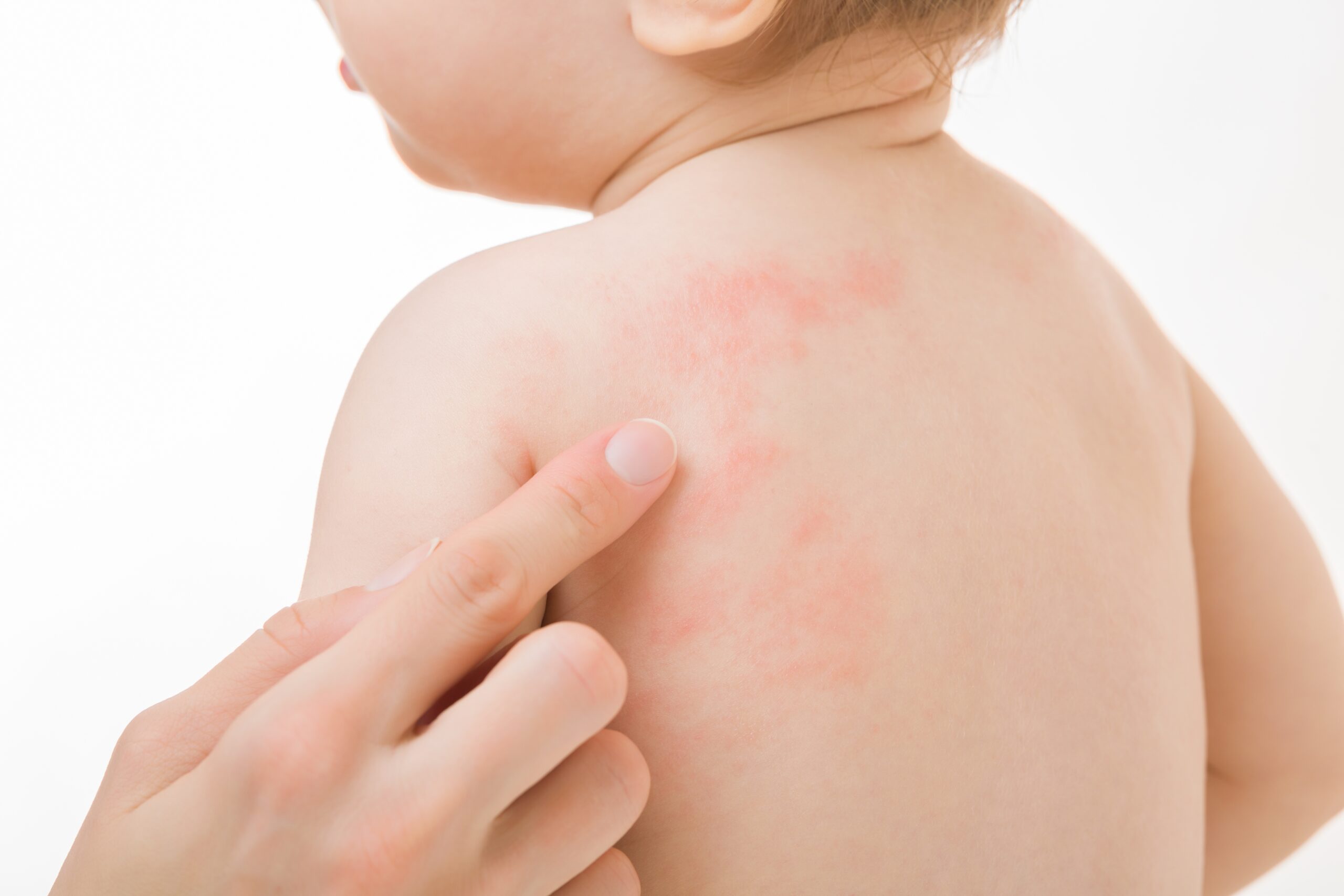 How to Manage Skin Rashes in Children