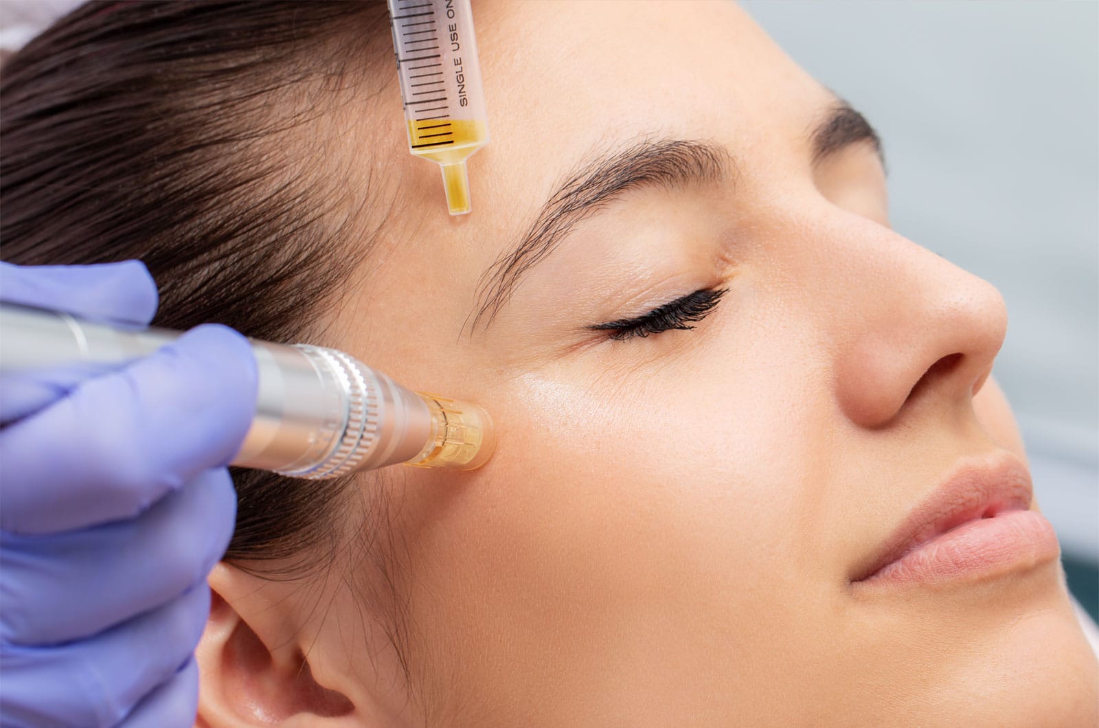 Microneedling for a Brighter Complexion